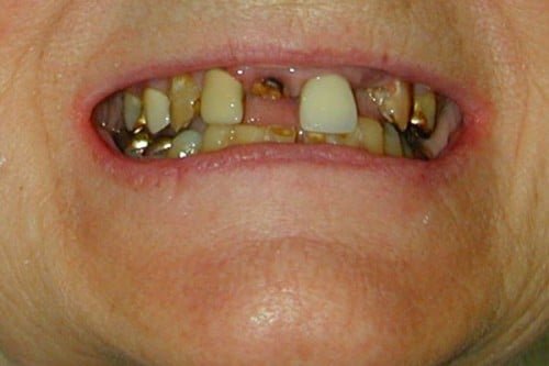 closeup of a smile with missing and decayed teeth