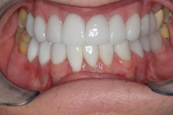 closeup of smile with new dental crowns