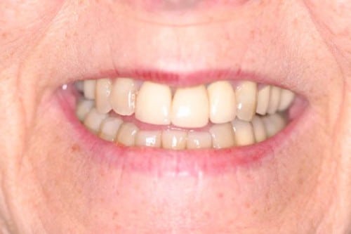closeup of older woman with decayed, damaged teeth