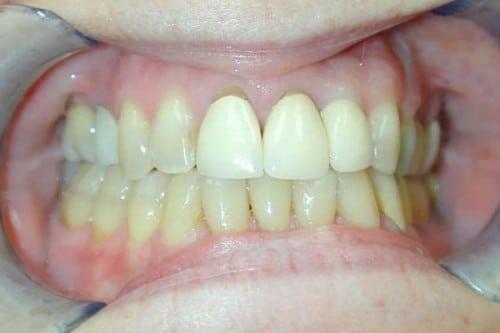 closeup of teeth before new dental crowns