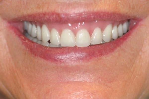 results of patient with implant supported dentures