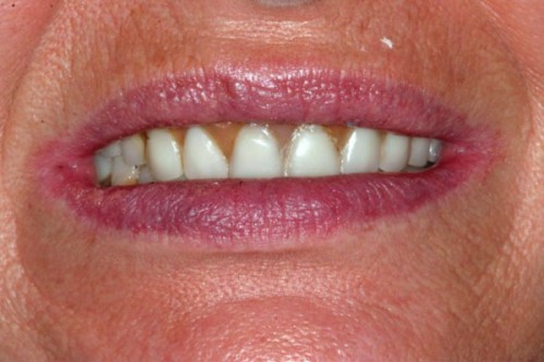 before closeup of patient wanting implant supported dentures
