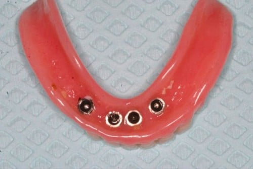 closeup of implant supported denture