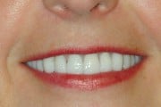 closeup of woman with new dental implants