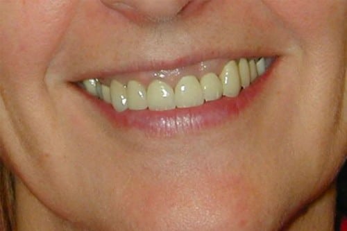 closeup of a woman's teeth before a full mouth reconstruction