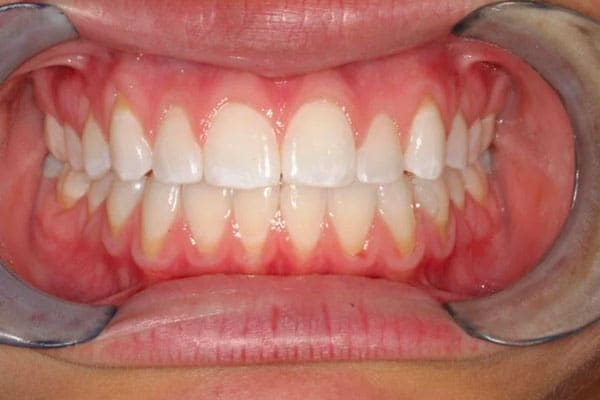 closeup of teeth after braces