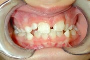 a closeup of a smile before orthodontic treatment
