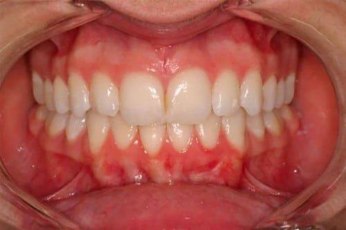 closeup of a new, straighter smile thanks to orthodontics