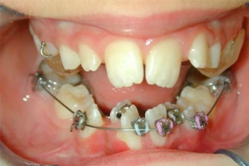 crooked smile with traditional metal braces attached