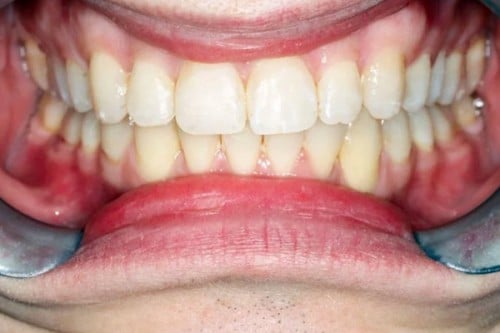 New, straighter smile thanks to orthodontics