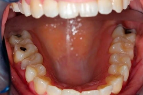 closeup of a mouth after straightening smile