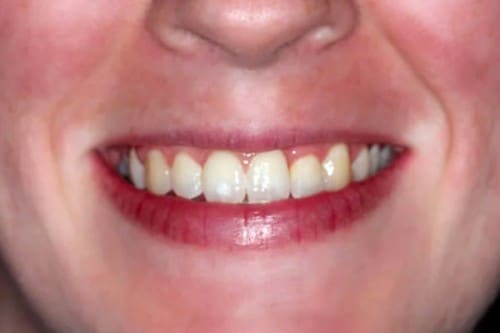 closeup of a woman's smile after orthodontics