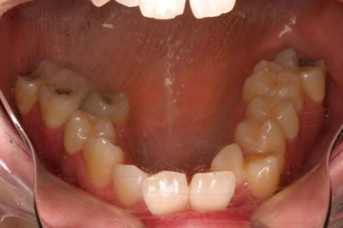 closeup of mouth before orthodontic treatment