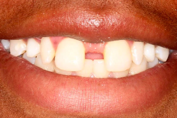 closeup of a smile with large gap in between two front teeth
