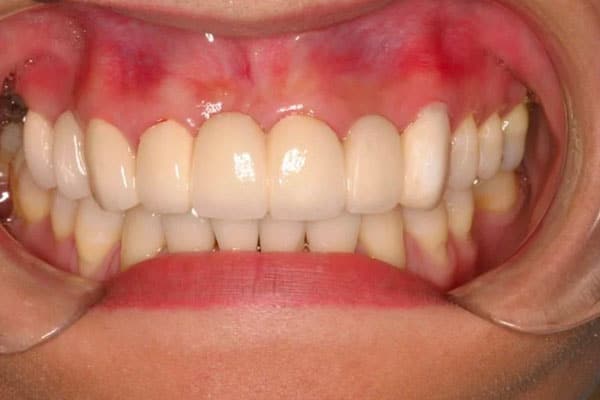 benefits of a new smile with a precision bridge