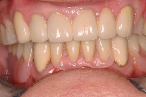 results of new dentures and porcelain dental crowns
