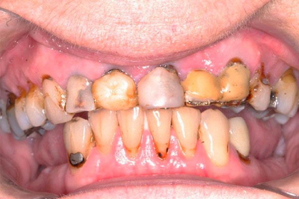 worn, decayed and damaged teeth
