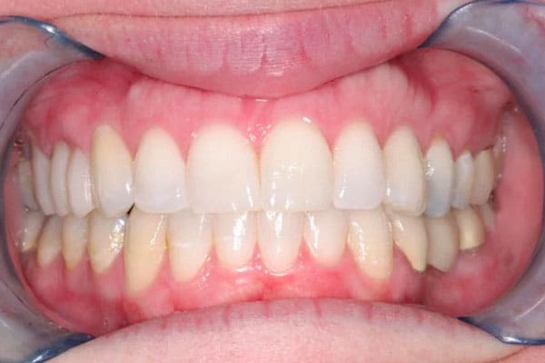 benefits of Zoom! Teeth Whitening
