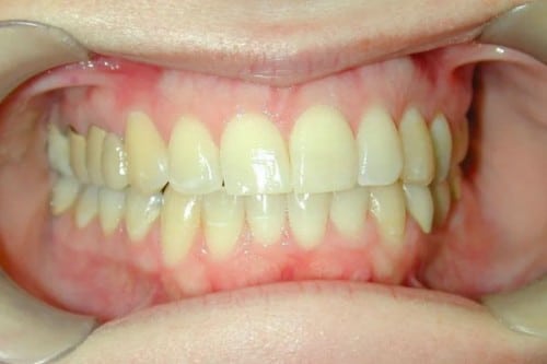a smile before the benefits of Zoom! Teeth Whitening