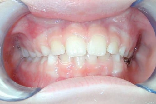 benefits of Zoom! Teeth Whitening