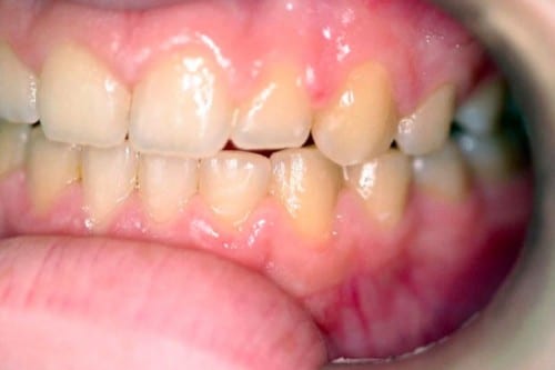 smile before tooth whitening