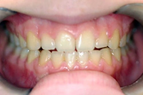 yellow, discolored teeth